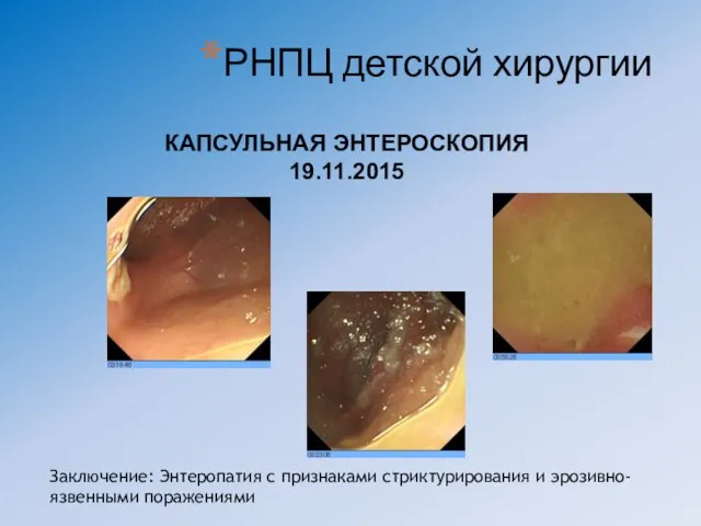 Заключение: Энтеропатия с признаками стриктурирования и эрозивно- язвенными поражениями КАПСУЛЬНАЯ ЭНТЕРОСКОПИЯ 19.11.2015 РНПЦ детской хирургии