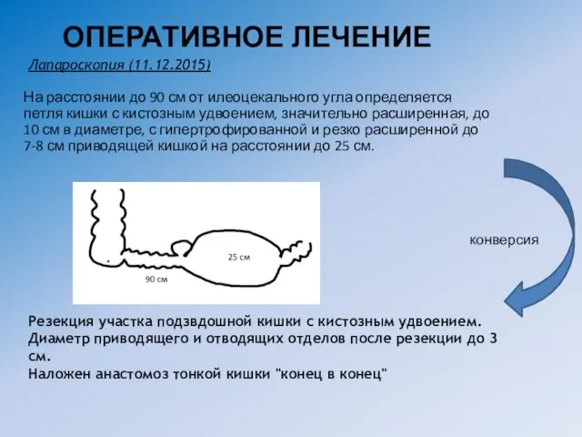 ОПЕРАТИВНОЕ ЛЕЧЕНИЕ На расстоянии до 90 см от илеоцекального угла определяется