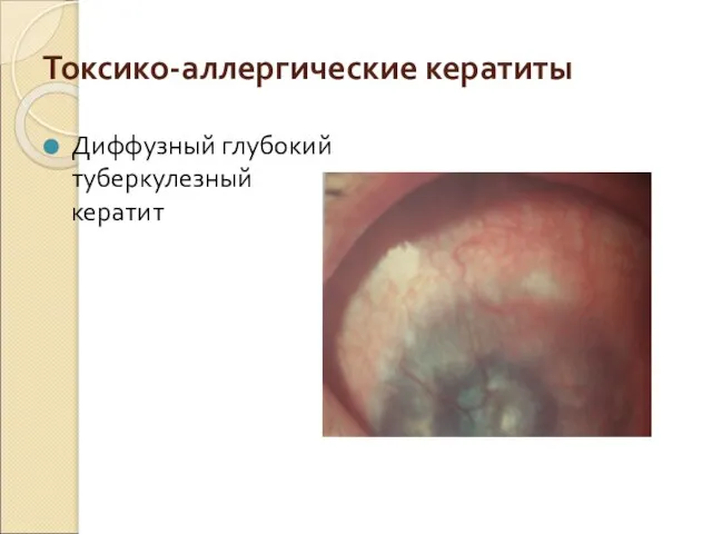 Токсико-аллергические кератиты Диффузный глубокий туберкулезный кератит