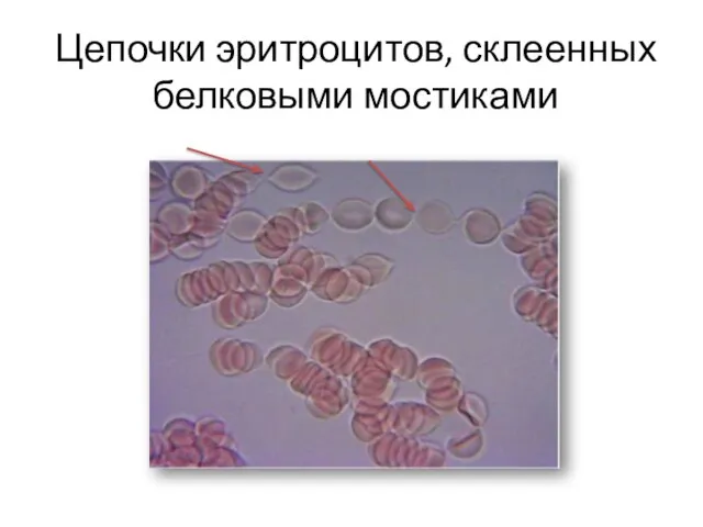 Цепочки эритроцитов, склеенных белковыми мостиками