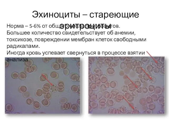 Эхиноциты – стареющие эритроциты Норма – 5-6% от общего числа эритроцитов.