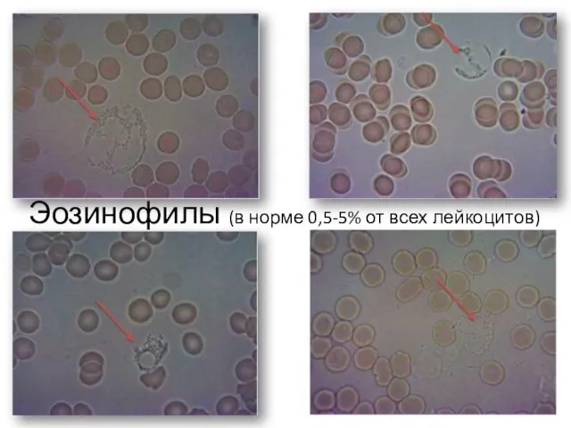 Эозинофилы (в норме 0,5-5% от всех лейкоцитов)