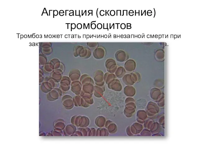 Агрегация (скопление) тромбоцитов Тромбоз может стать причиной внезапной смерти при закупорке крупных сосудов мозга или сердца.