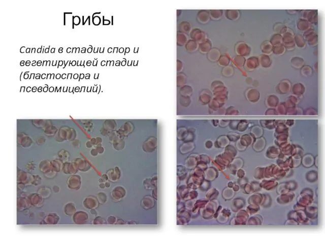 Грибы Candida в стадии спор и вегетирующей стадии (бластоспора и псевдомицелий).