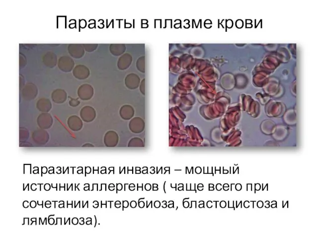 Паразиты в плазме крови Паразитарная инвазия – мощный источник аллергенов (