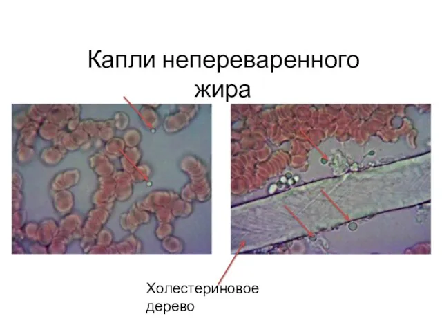 Капли непереваренного жира Холестериновое дерево