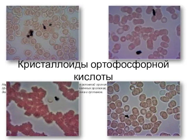 Кристаллоиды ортофосфорной кислоты Нарушения фосфорно-кальциевого обмена являются основной причиной развития остеопороза,