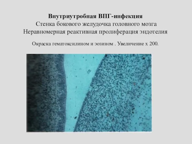 Внутриутробная ВПГ-инфекция Стенка бокового желудочка головного мозга Неравномерная реактивная пролиферация эндотелия