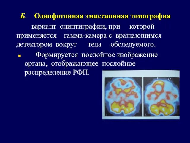 Б. Однофотонная эмиссионная томография вариант сцинтиграфии, при которой применяется гамма-камера с