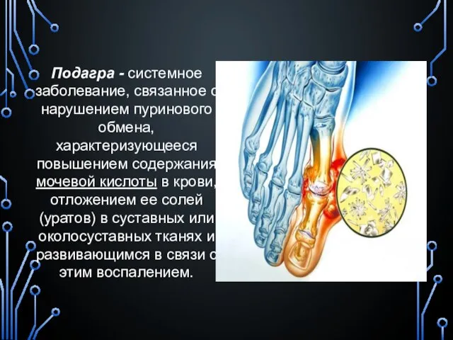 Подагра - системное заболевание, связанное с нарушением пуринового обмена, характеризующееся повышением