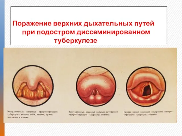 Поражение верхних дыхательных путей при подостром диссеминированном туберкулезе