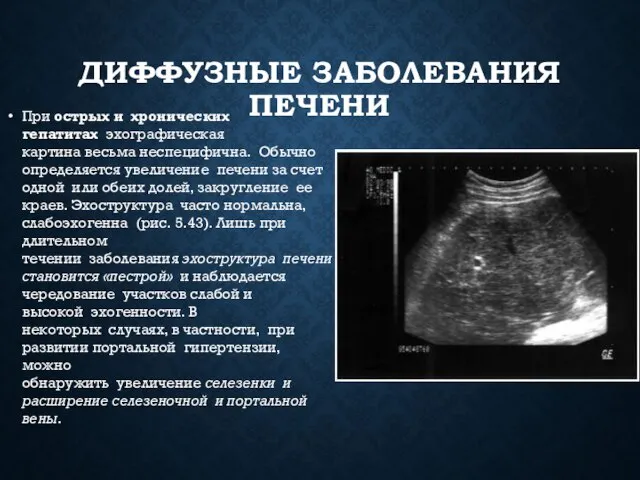 ДИФФУЗНЫЕ ЗАБОЛЕВАНИЯ ПЕЧЕНИ При острых и хронических гепатитах эхографическая картина весьма