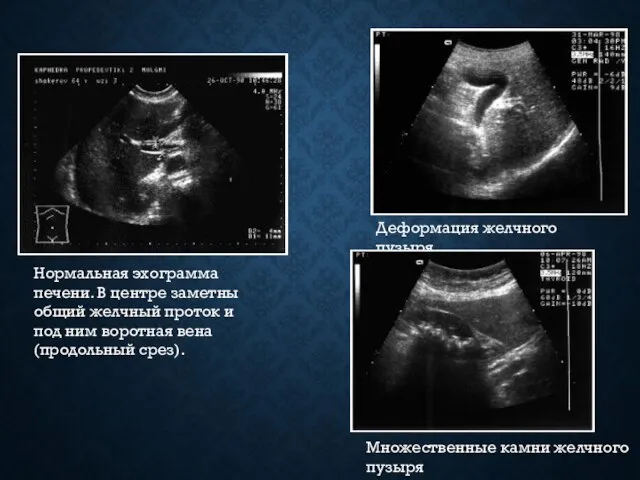 Нормальная эхограмма печени. В центре заметны общий желчный проток и под
