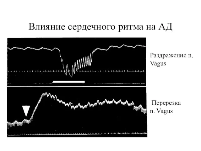 Влияние сердечного ритма на АД Раздражение n. Vagus Перерезка n. Vagus