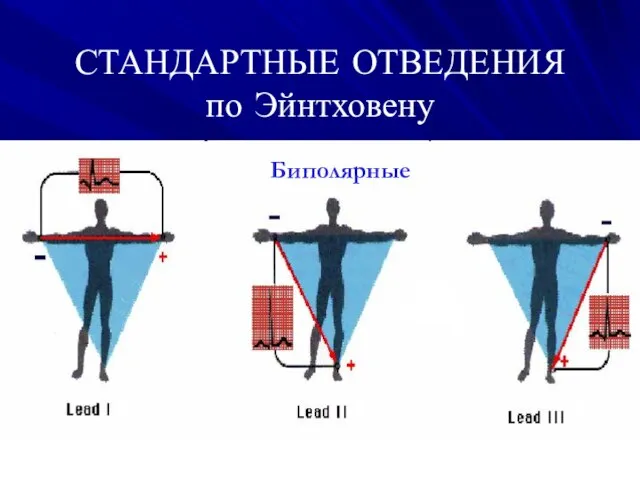 СТАНДАРТНЫЕ ОТВЕДЕНИЯ по Эйнтховену‏ Биполярные