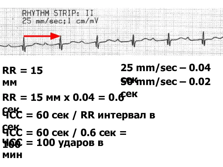 25 mm/sec – 0.04 сек 50 mm/sec – 0.02 сек RR