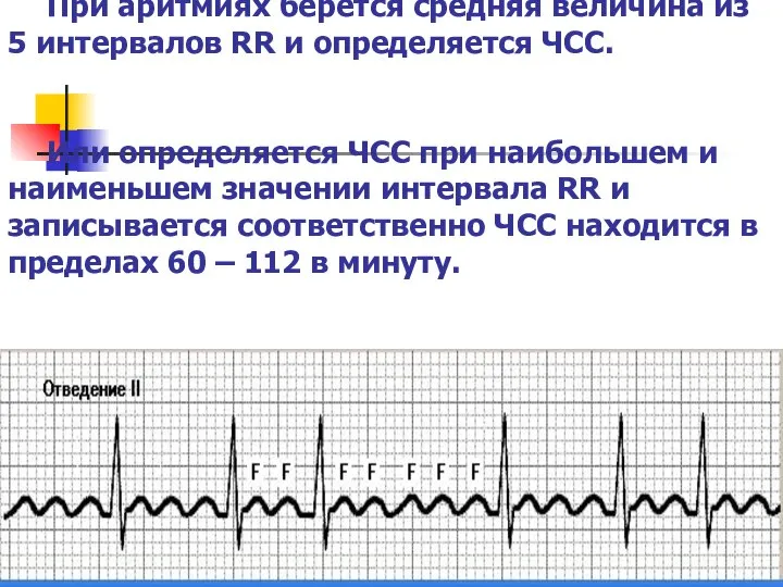 При аритмиях берется средняя величина из 5 интервалов RR и определяется