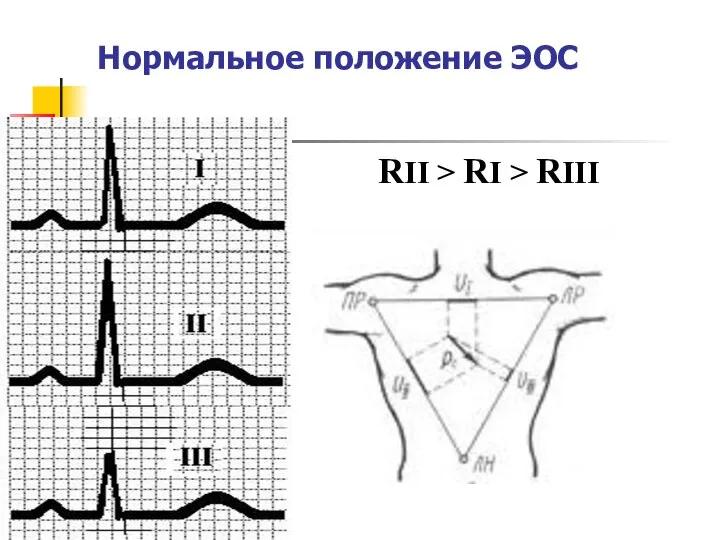 Нормальное положение ЭОС RII > RI > RIII