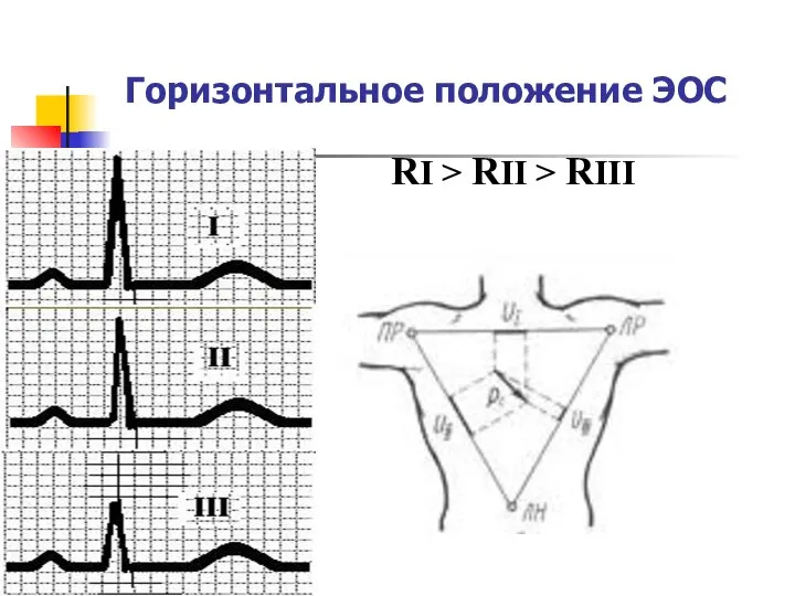 Горизонтальное положение ЭОС RI > RII > RIII