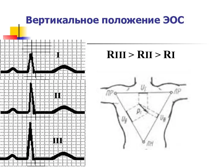 Вертикальное положение ЭОС RIII > RII > RI