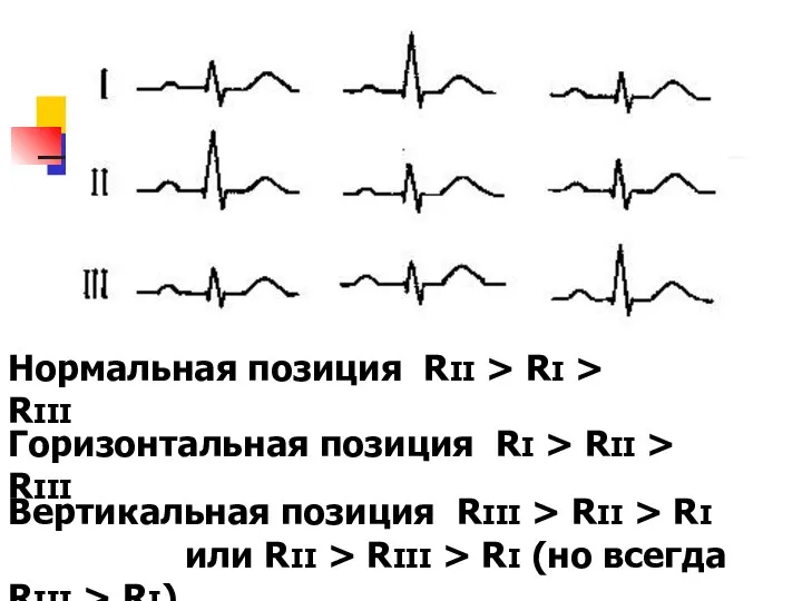 Нормальная позиция RII > RI > RIII Горизонтальная позиция RI >