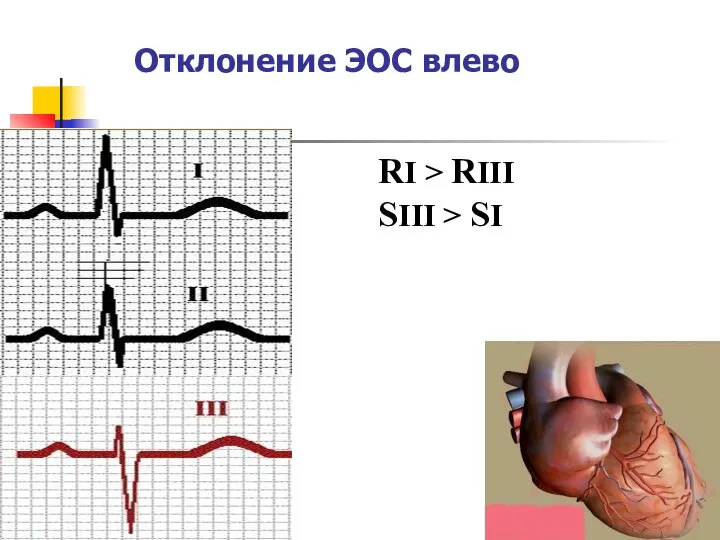 Отклонение ЭОС влево RI > RIII SIII > SI