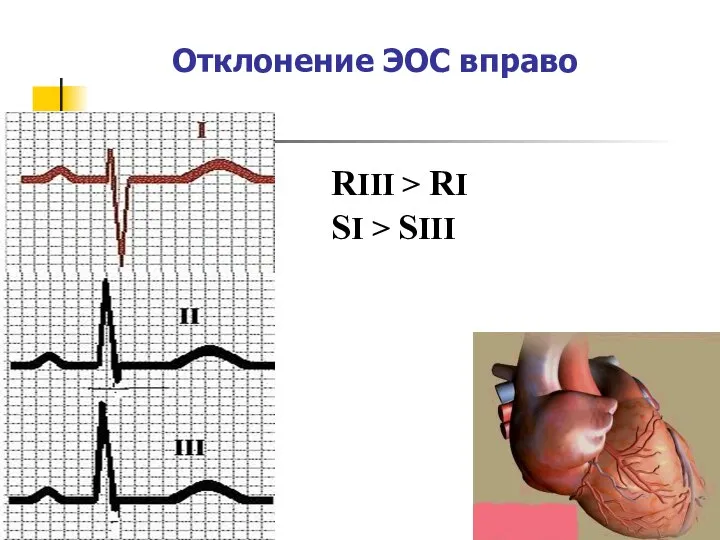 Отклонение ЭОС вправо RIII > RI SI > SIII