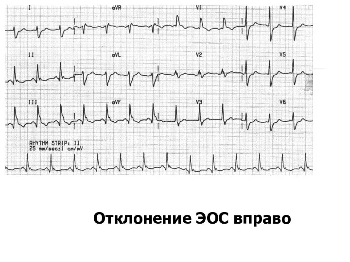 Отклонение ЭОС вправо