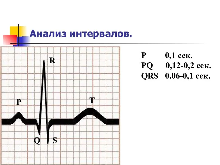 Анализ интервалов. P 0,1 сек. PQ 0,12-0,2 сек. QRS 0.06-0,1 сек. P Q R S T