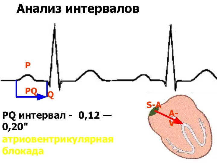 Анализ интервалов PQ интервал - 0,12 — 0,20" Q P PQ A-V S-A атриовентрикулярная блокада
