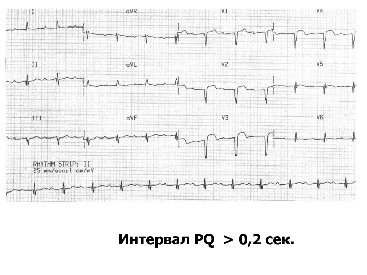 Интервал PQ > 0,2 сек.