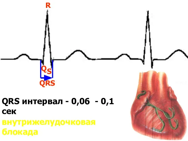 QRS интервал - 0,06 - 0,1сек внутрижелудочковая блокада QRS S Q R