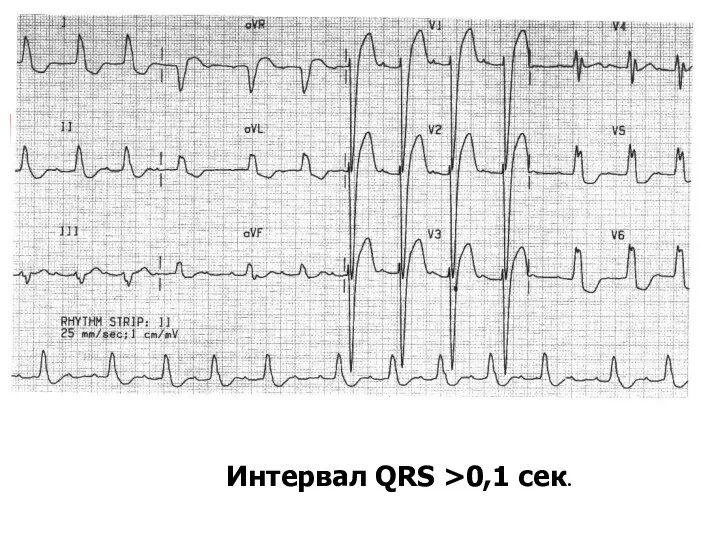 Интервал QRS >0,1 сек.