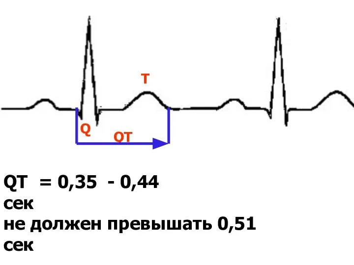 QT = 0,35 - 0,44 сек не должен превышать 0,51 сек Q QT T