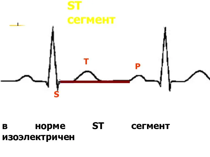 ST сегмент в норме ST сегмент изоэлектричен T S P