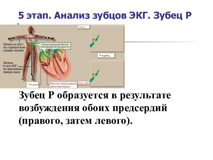 5 этап. Анализ зубцов ЭКГ. Зубец Р Зубец Р образуется в