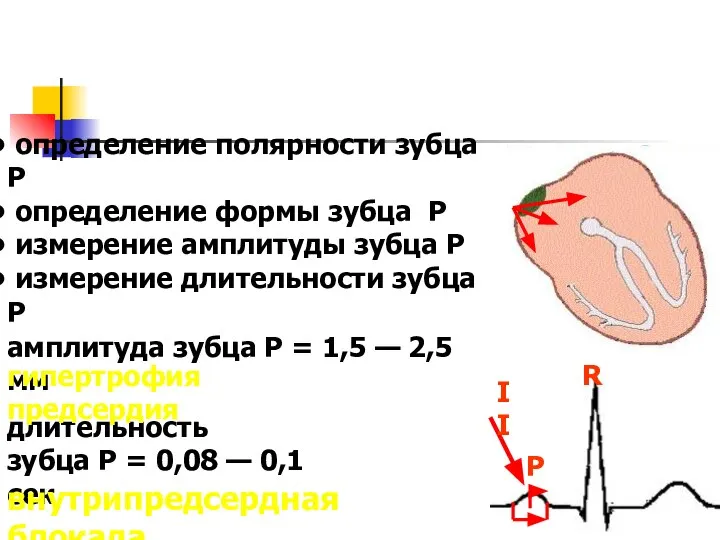 определение полярности зубца P определение формы зубца P измерение амплитуды зубца