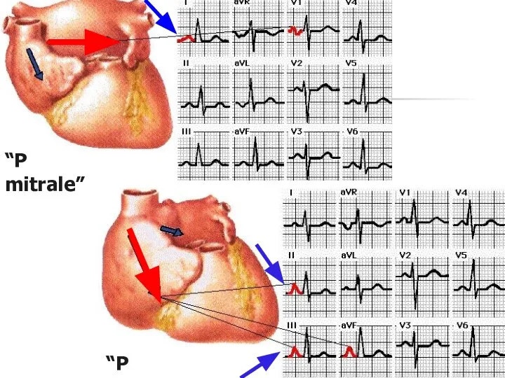 “P mitrale” “P pulmonale”