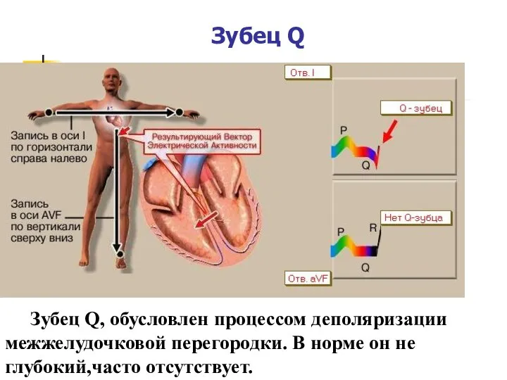 Зубец Q Зубец Q, обусловлен процессом деполяризации межжелудочковой перегородки. В норме он не глубокий,часто отсутствует.