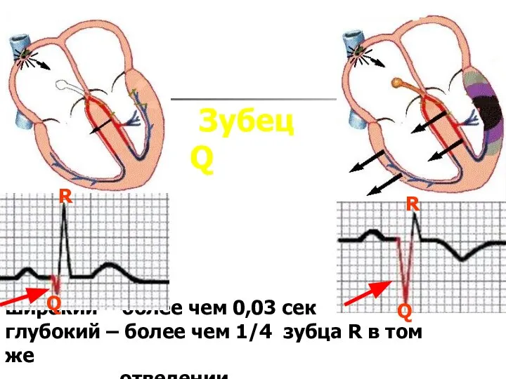 Зубец Q широкий – более чем 0,03 сек глубокий – более