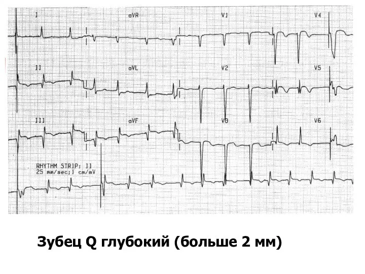 Зубец Q глубокий (больше 2 мм)