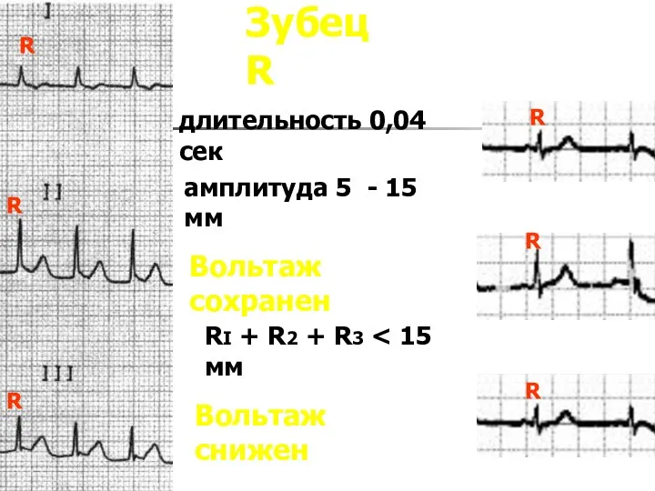 Зубец R длительность 0,04 сек амплитуда 5 - 15 мм Вольтаж