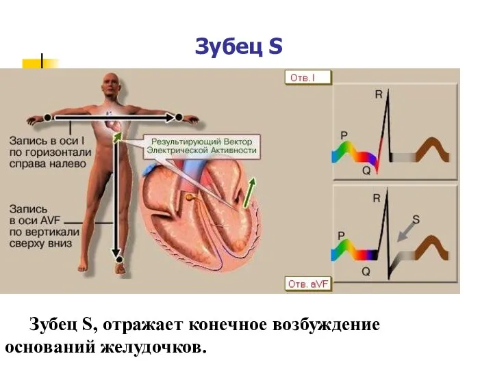 Зубец S Зубец S, отражает конечное возбуждение оснований желудочков.