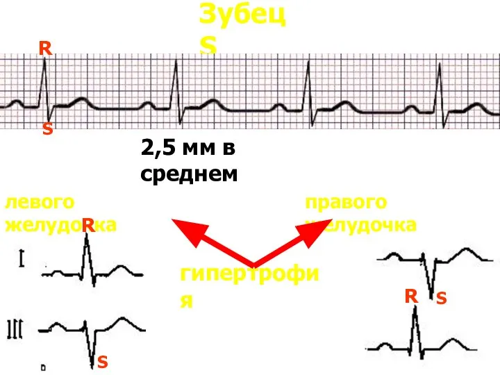 Зубец S 2,5 мм в среднем S гипертрофия правого желудочка левого
