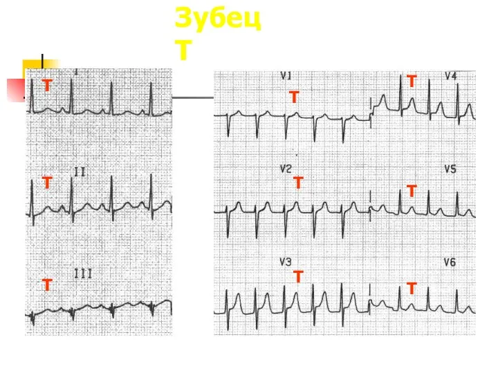 Зубец T T T T T T T T T T