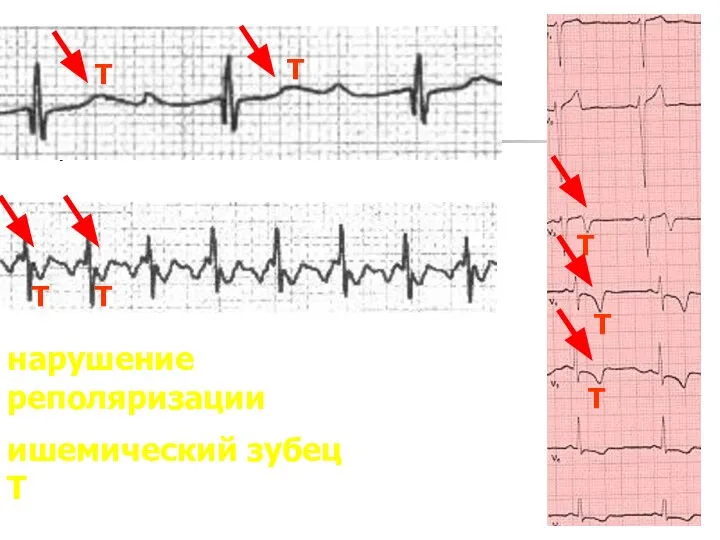нарушение реполяризации ишемический зубец T T T T T T T T