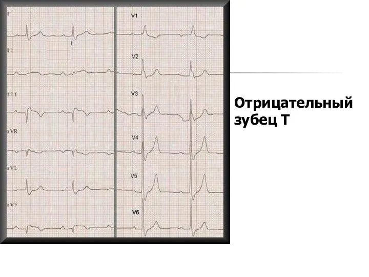 Отрицательный зубец Т