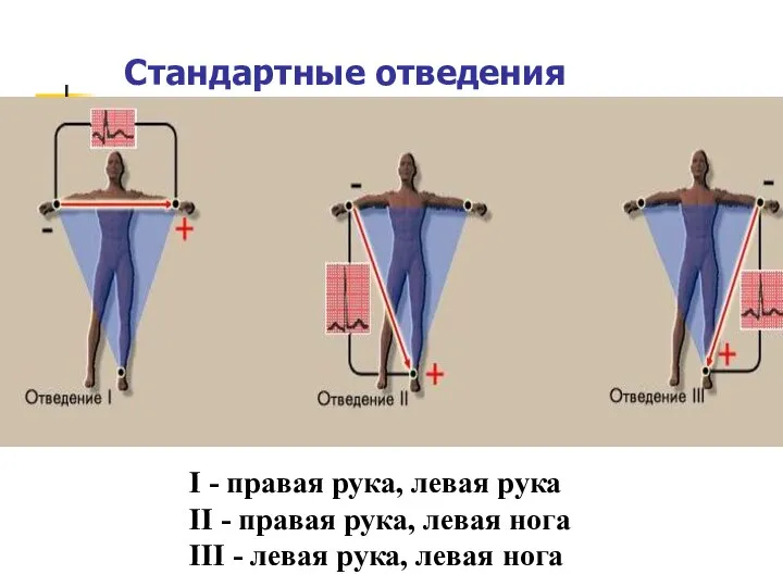 Стандартные отведения I - правая рука, левая рука II - правая