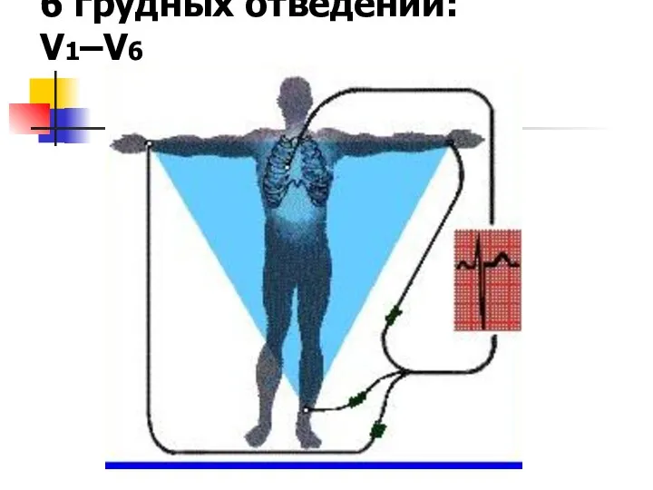 6 грудных отведений: V1–V6