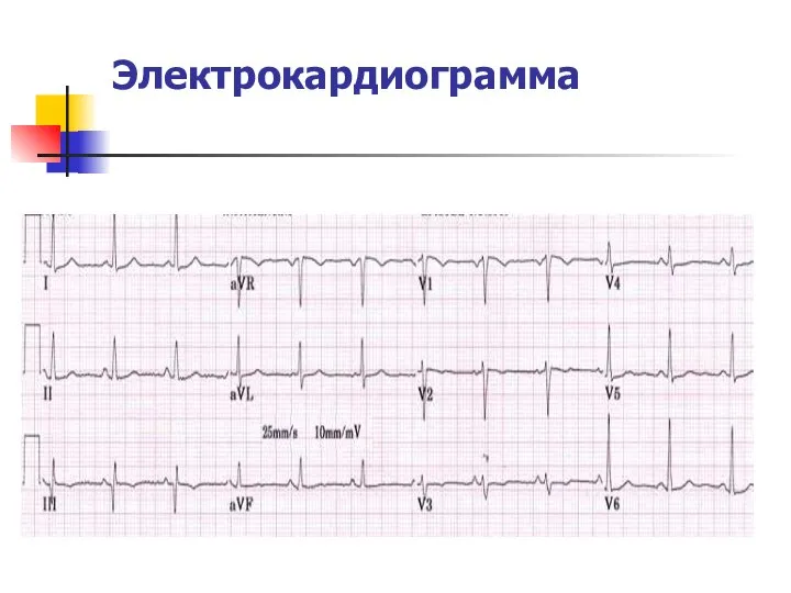 Электрокардиограмма